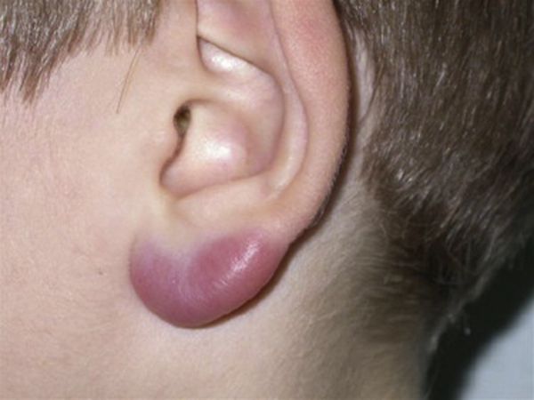 Боррелиозная лимфоцитома [9]