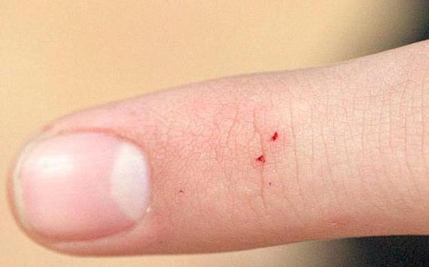 как выглядит укус каракурта