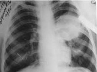 Эхинококкоз Эхинококкоз