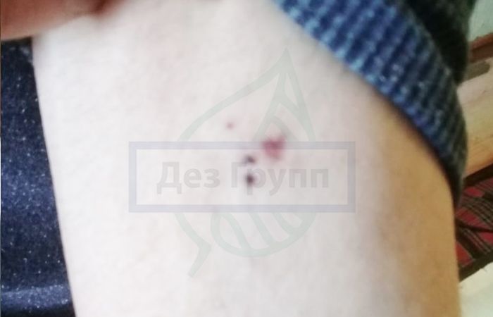 Собачий клещ - после укуса клещом Собачий клещ - после укуса клещом