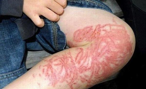 Ожог кубомедузы кубомедуза фото укуса