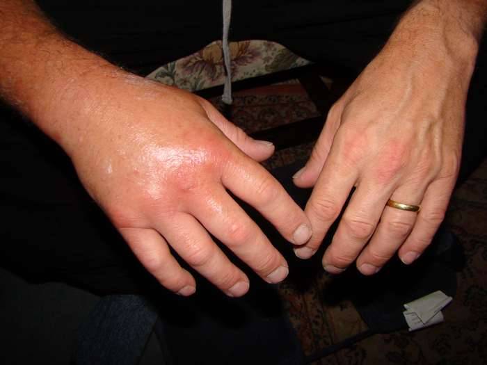 Рог ужалил Фото укуса шершня