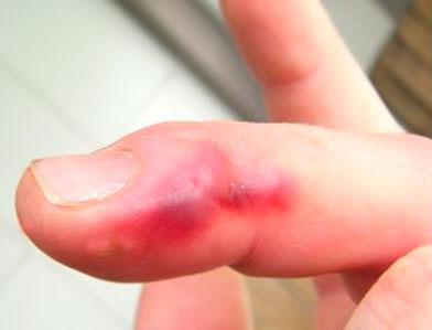 Укус сколопендры фото, след от укуса сколопендры у человека