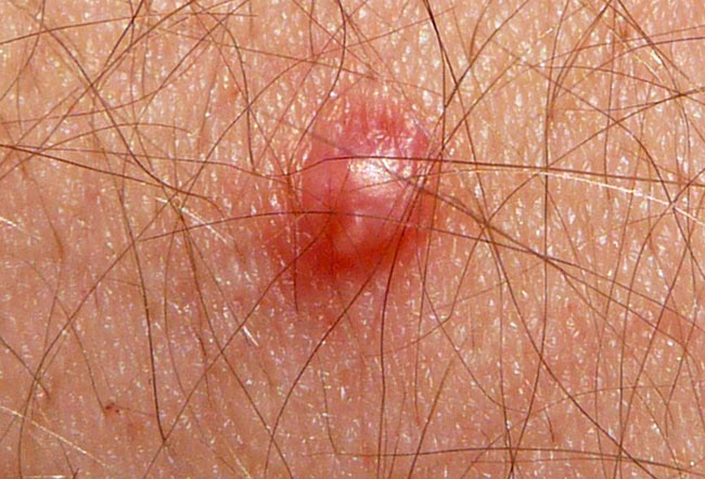 Личинка овода под кожей человека фото