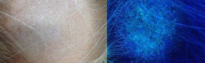 Особенности лампы Вуда в дерматологии