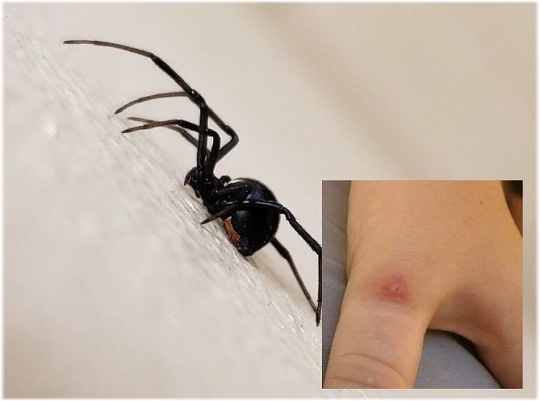 укус каракурта