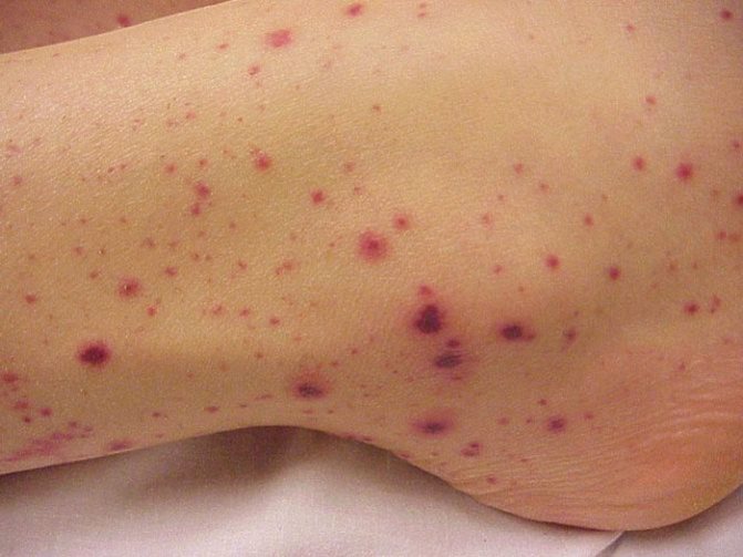 Жигалка:  описание насекомого, особенности, виды, образ жизни